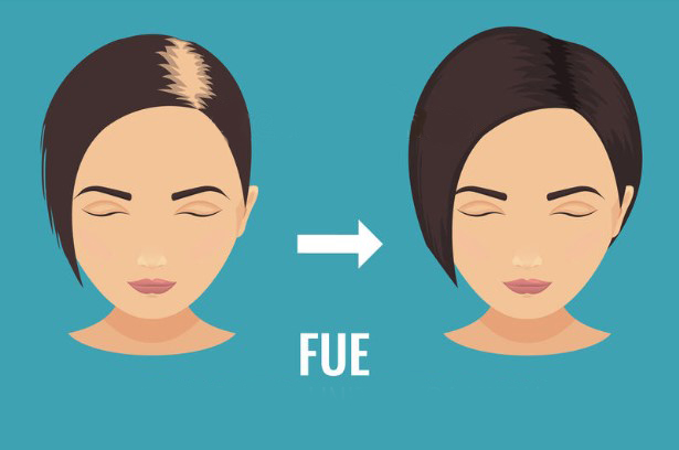 What is FUE Hair Transplant Method?