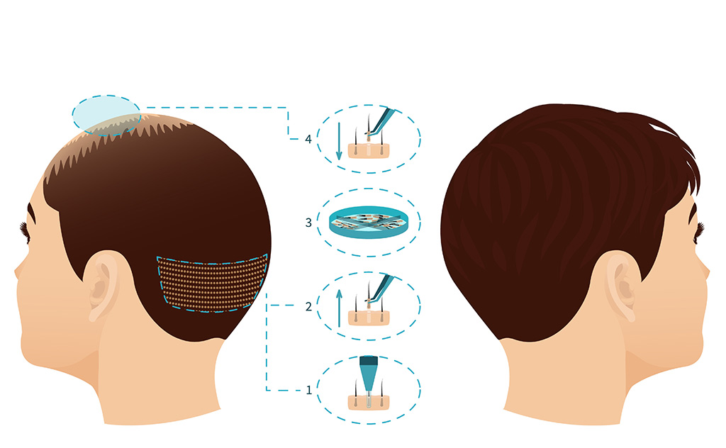 How Much is FUE Hair Transplant Price 2022? - Now Hair Time