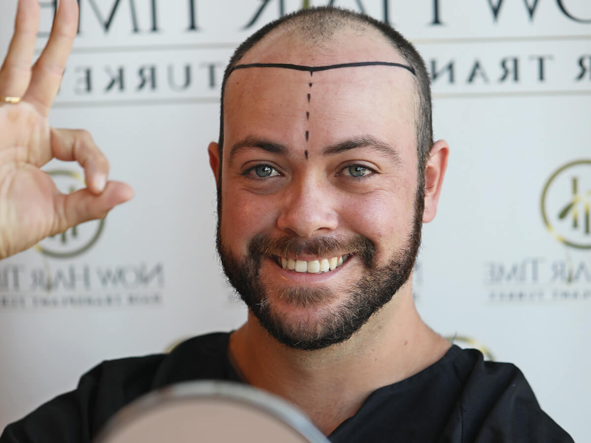hairtransplant-1.jpg