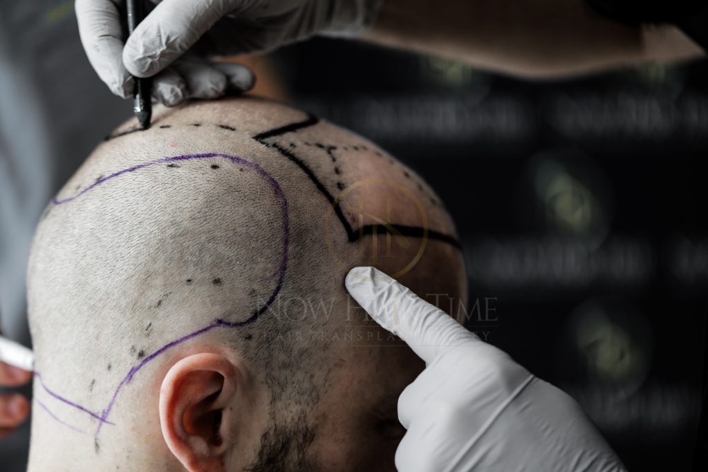 Hair Transplant 2022: The Complete Guide From A to Z - Now Hair Time