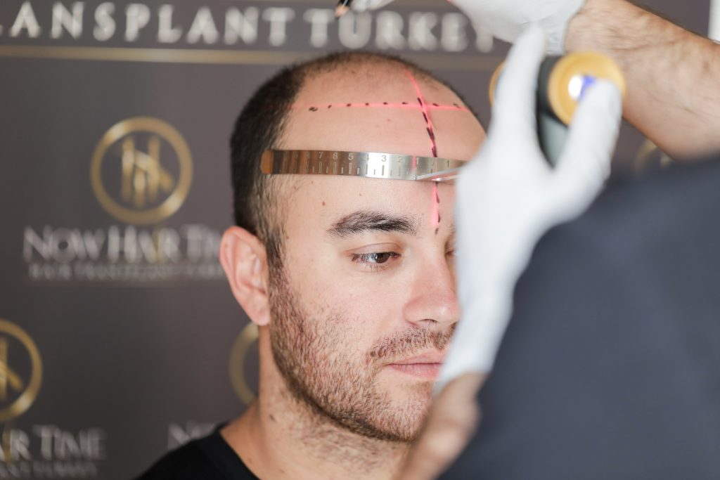 besthairtransplantcenterofturkey.jpeg