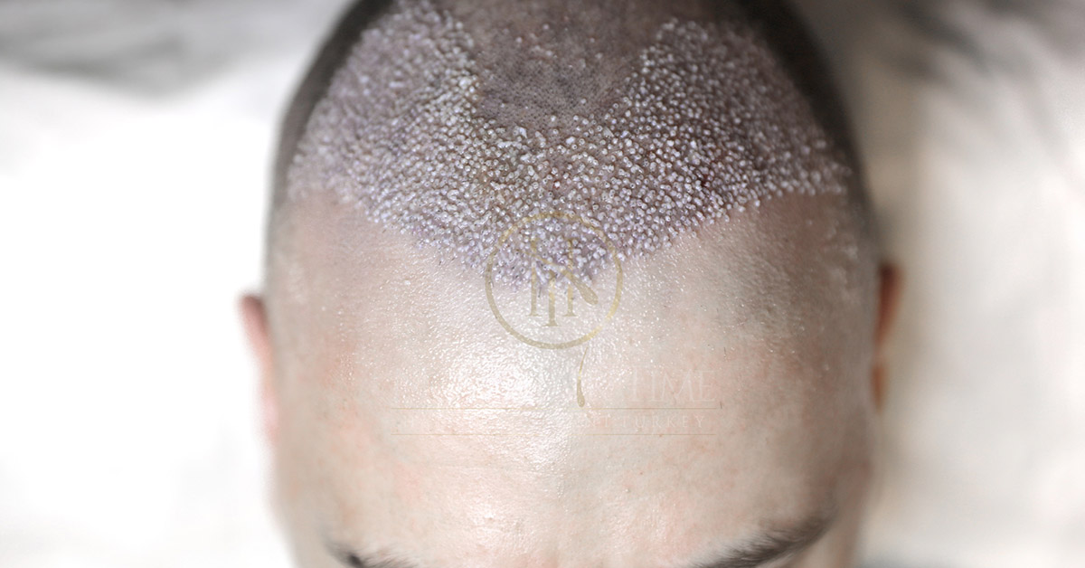 hairwashingafterhairtransplant.jpg