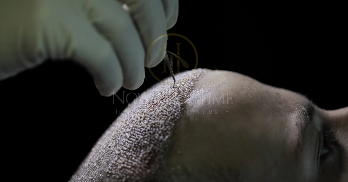 What Is Grey Hair Transplant?