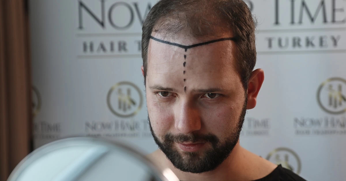 Cuidados Que se Deve Ter Antes do Transplante Capilar