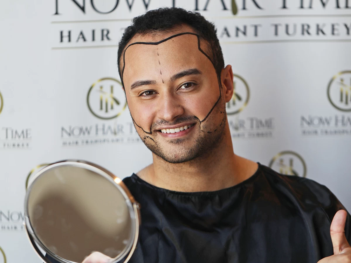 Il Trapianto Di Barba