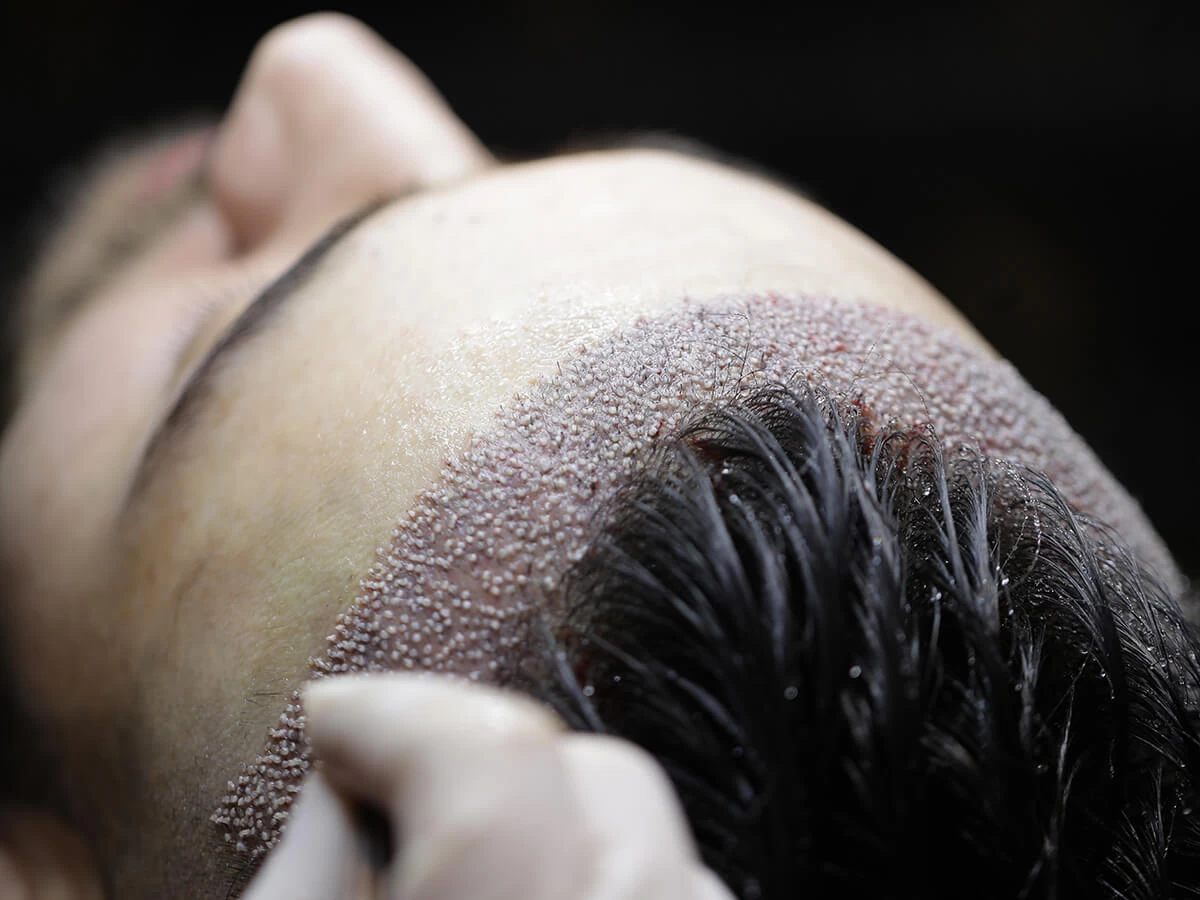 Trapianto Di Capelli Senza Rasatura
