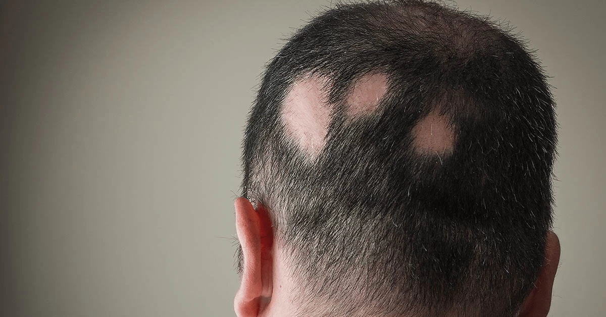 Alopecia Androgenética: O Problema da Alopecia Androgenética nos Homens