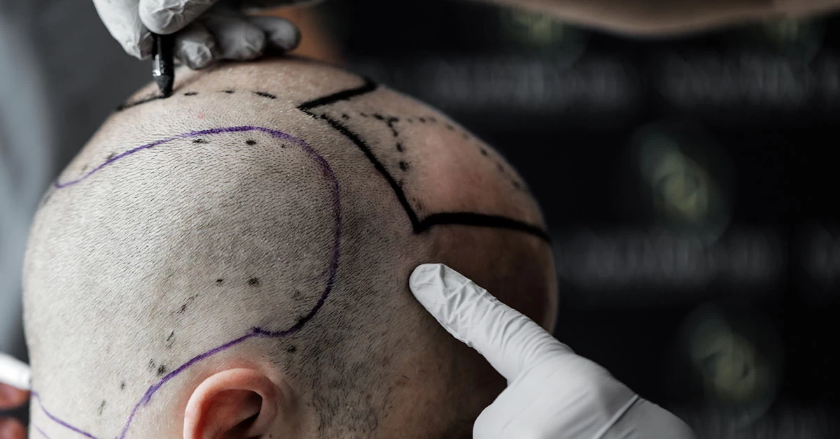 Ursachen für Haarausfall in jungen Jahren