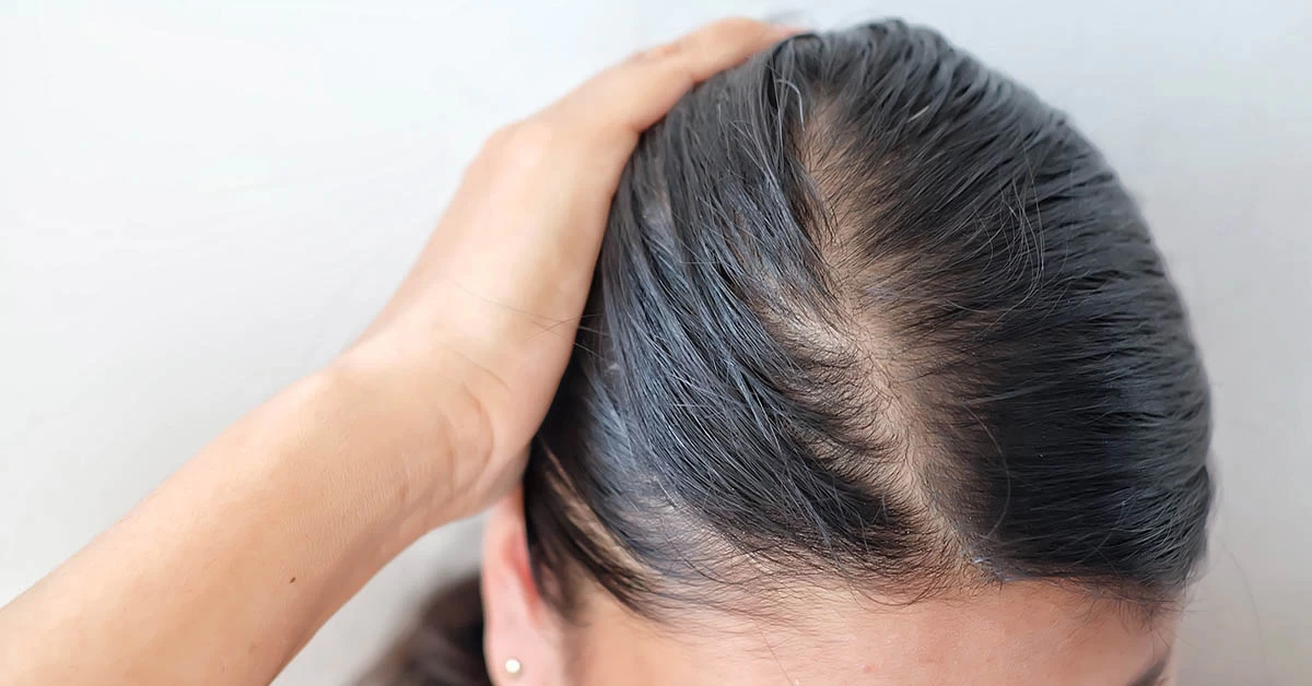 Haarausfall bei Frauen: Ursachen von Haarausfall bei Frauen