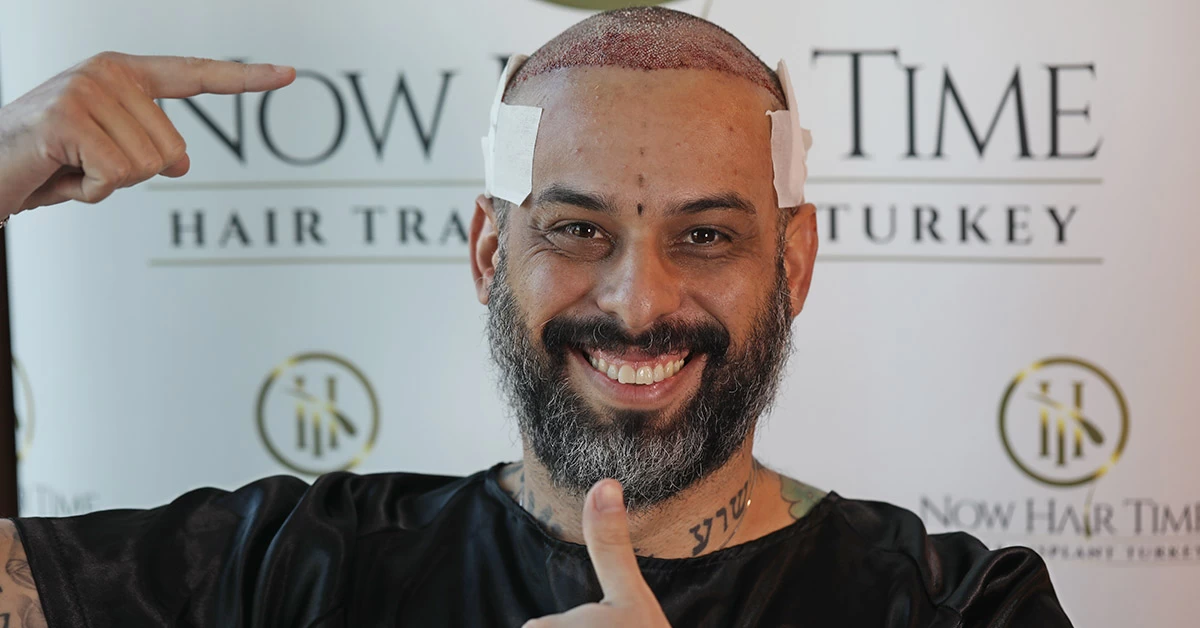 Nach der Haartransplantation: Was Sie jetzt wissen und beachten müssen