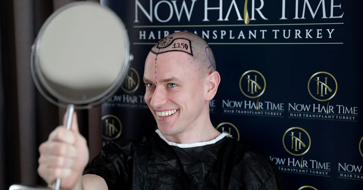 Haartransplantation: Mögliche Nebenwirkungen