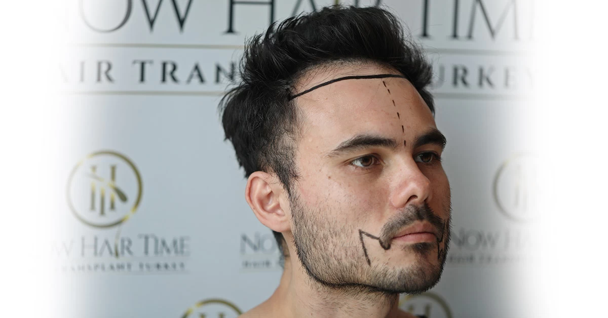 O Que é o Transplante de Barba?