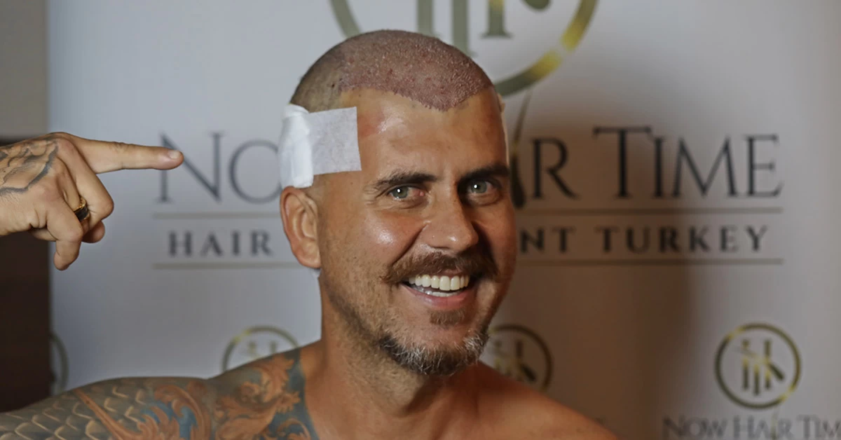 O Transplante Capilar é Feito no Verão?
