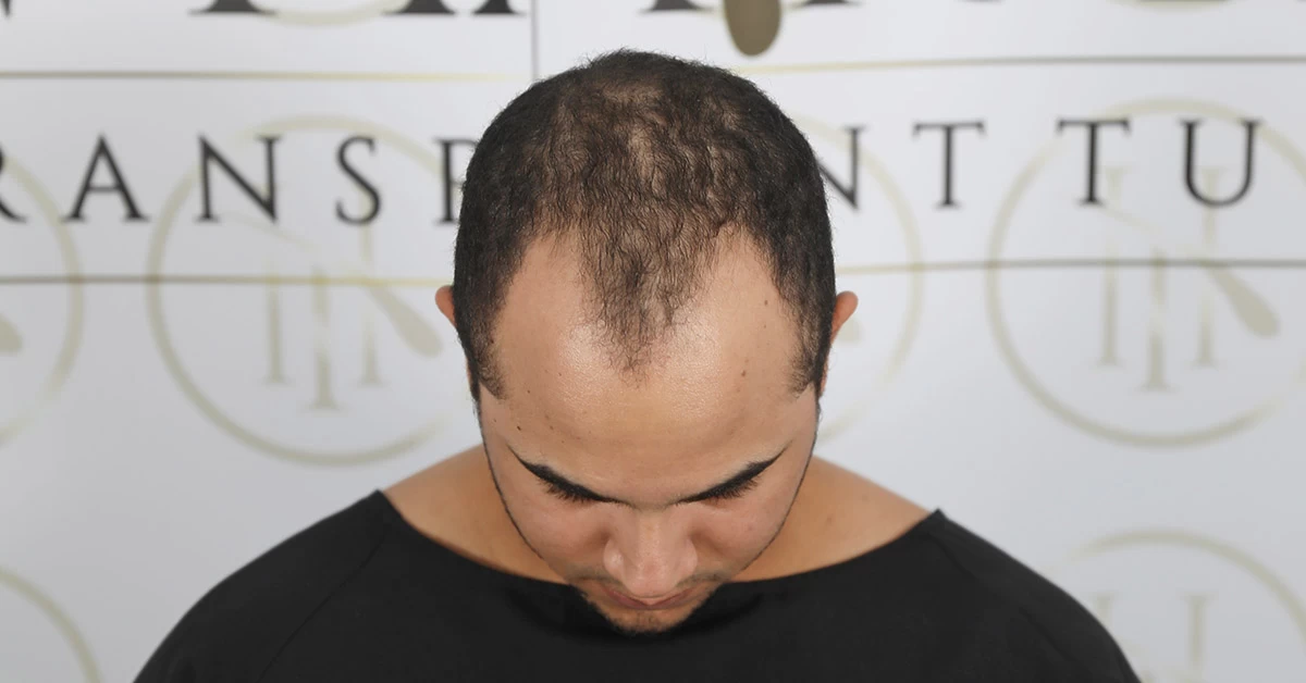 Perda de Cabelo em Idade Jovem