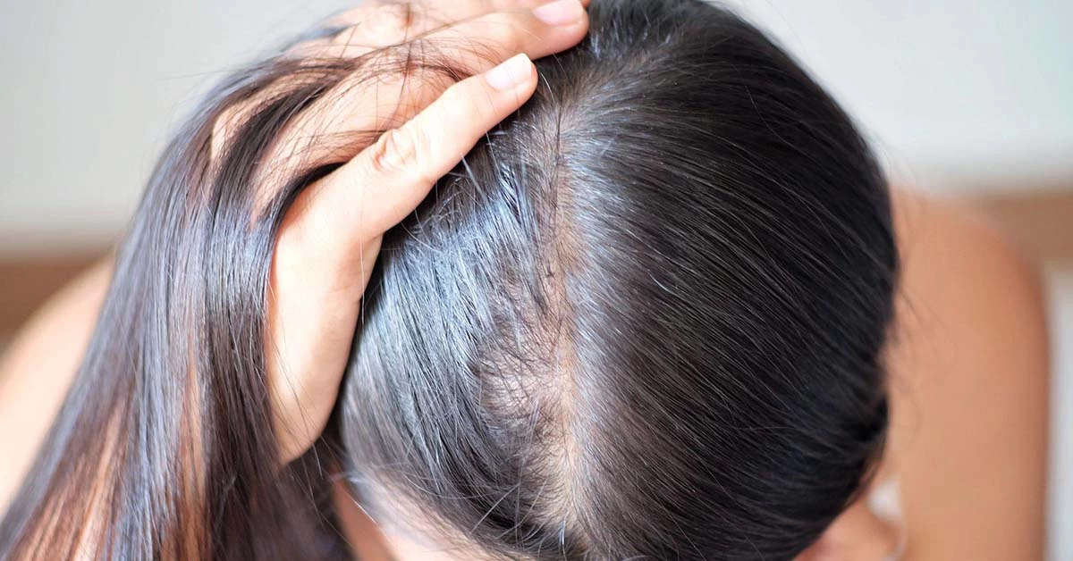 Perda de Cabelo nas Mulheres