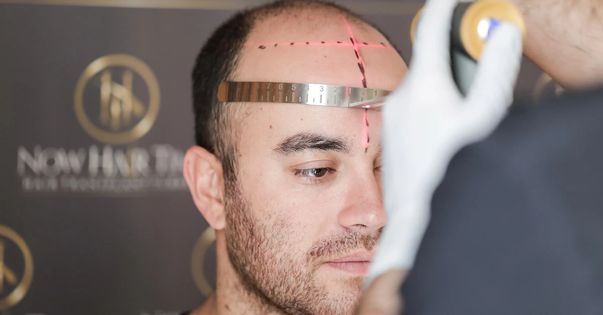 Planejamento em Transplante de Cabelo