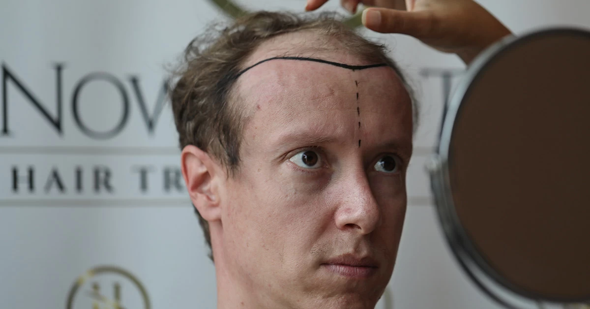 Problema de Cabelo Ralo?