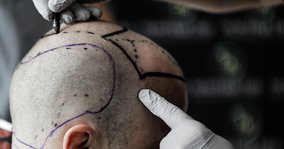 Quais São as Razões da Queda de Cabelo?