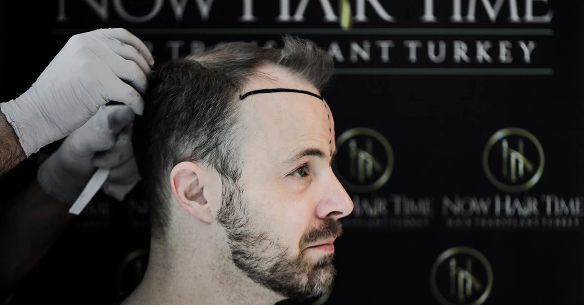 Quand Faut-Il Effectuer Une Greffe De Cheveux ?