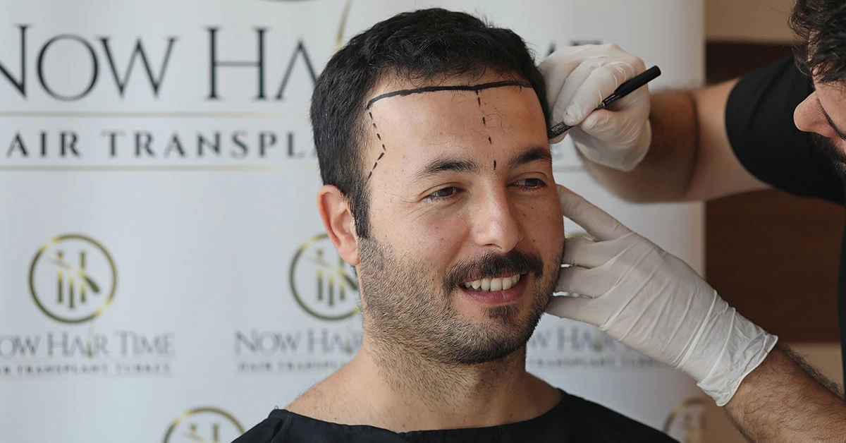 Qual è il periodo migliore per fare un Trapianto di Capelli?