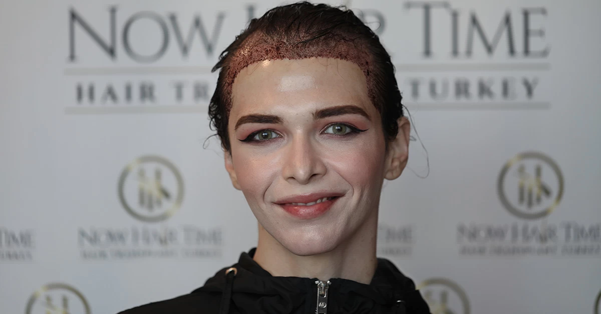 Transplante Capilar Em Mulheres