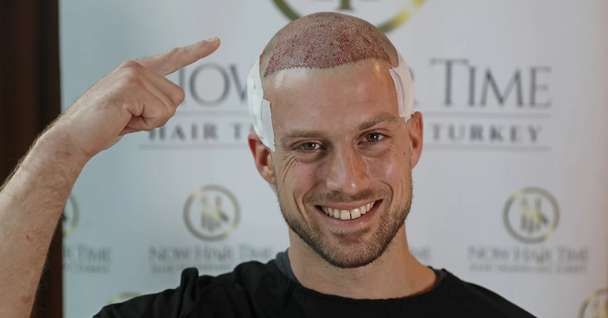 Tutto quello che c’è da sapere sul Trapianto di Capelli