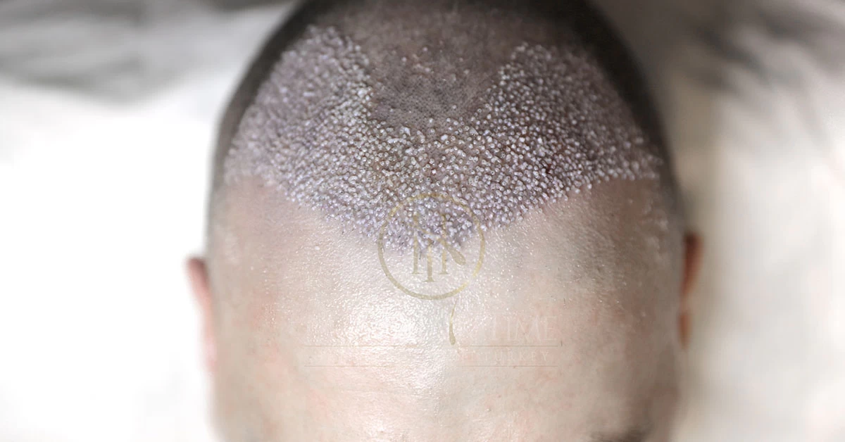 Warum kein Alkohol nach der Haartransplantation?