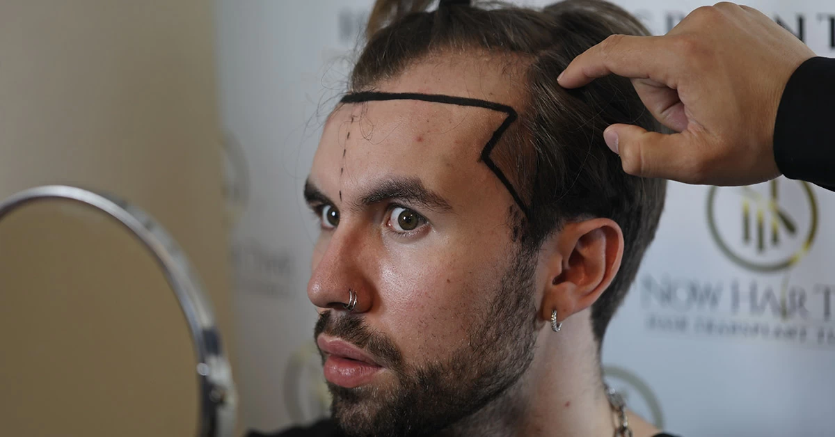Welke haartransplantatiemethode is beter?