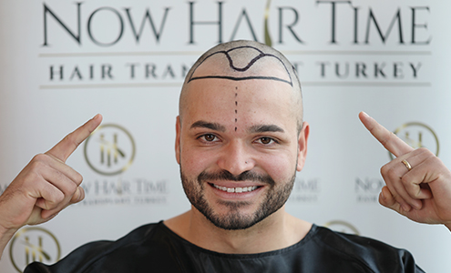 Affordable Hair Transplant Prices