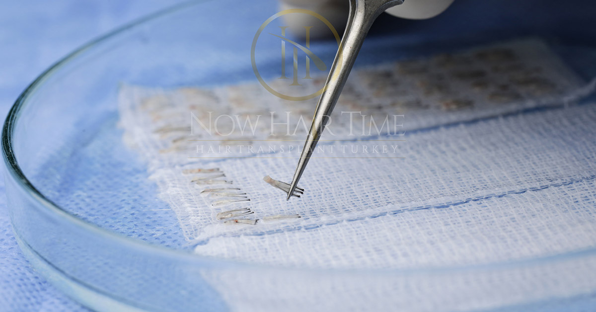 What Does Graft Mean in Hair Transplant?