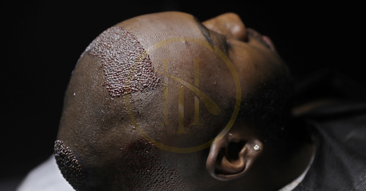 afro-sac-nedir-afro-sacli-bireylere-ekim-yapilabilir-mi.jpg