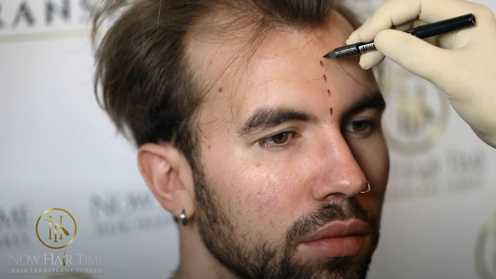 How Does the Hair Transplant Process Work?