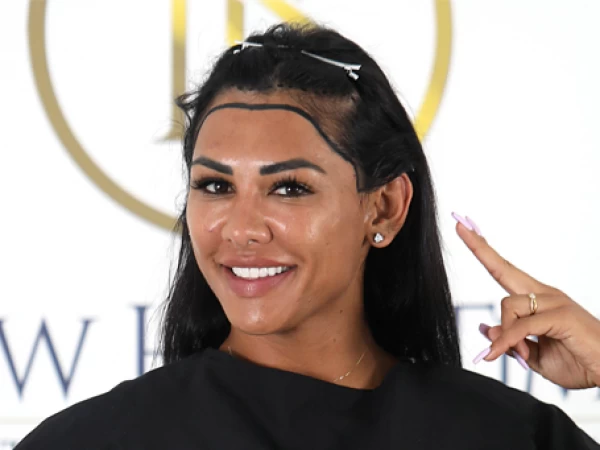 Female Hair Transplant