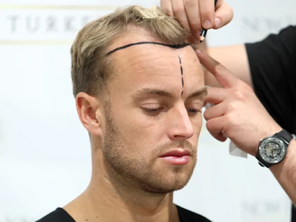 Hair Transplant