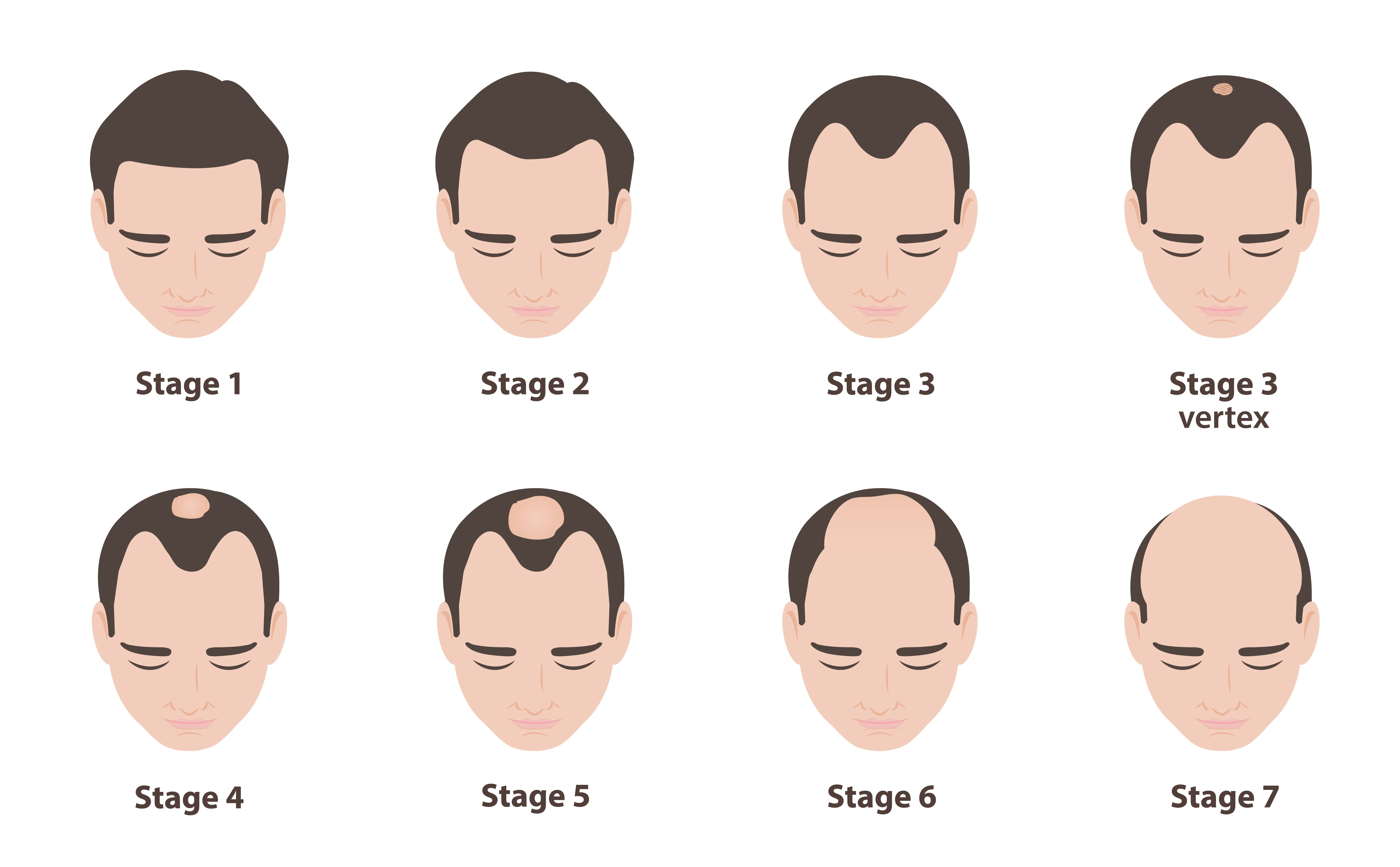 norwood-scale-stages-1-to-7.jpeg