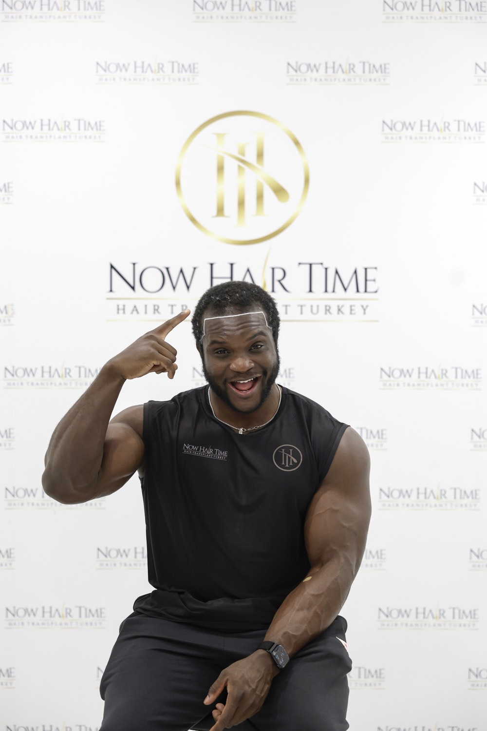 Afro hair transplant patient at Now Hair Time, Istanbul