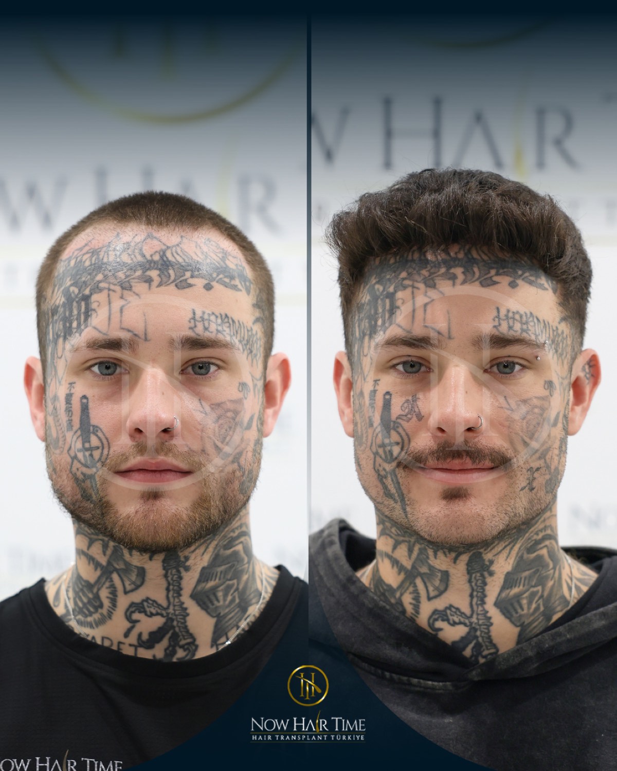 Hair transplant patient at Now Hair Time, Istanbul