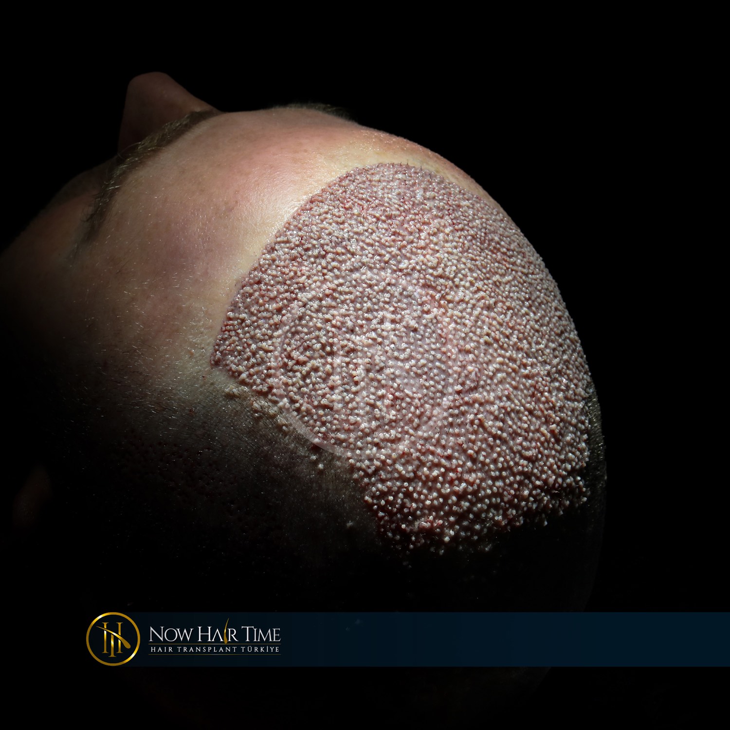 Hair transplant patient at Now Hair Time, Istanbul