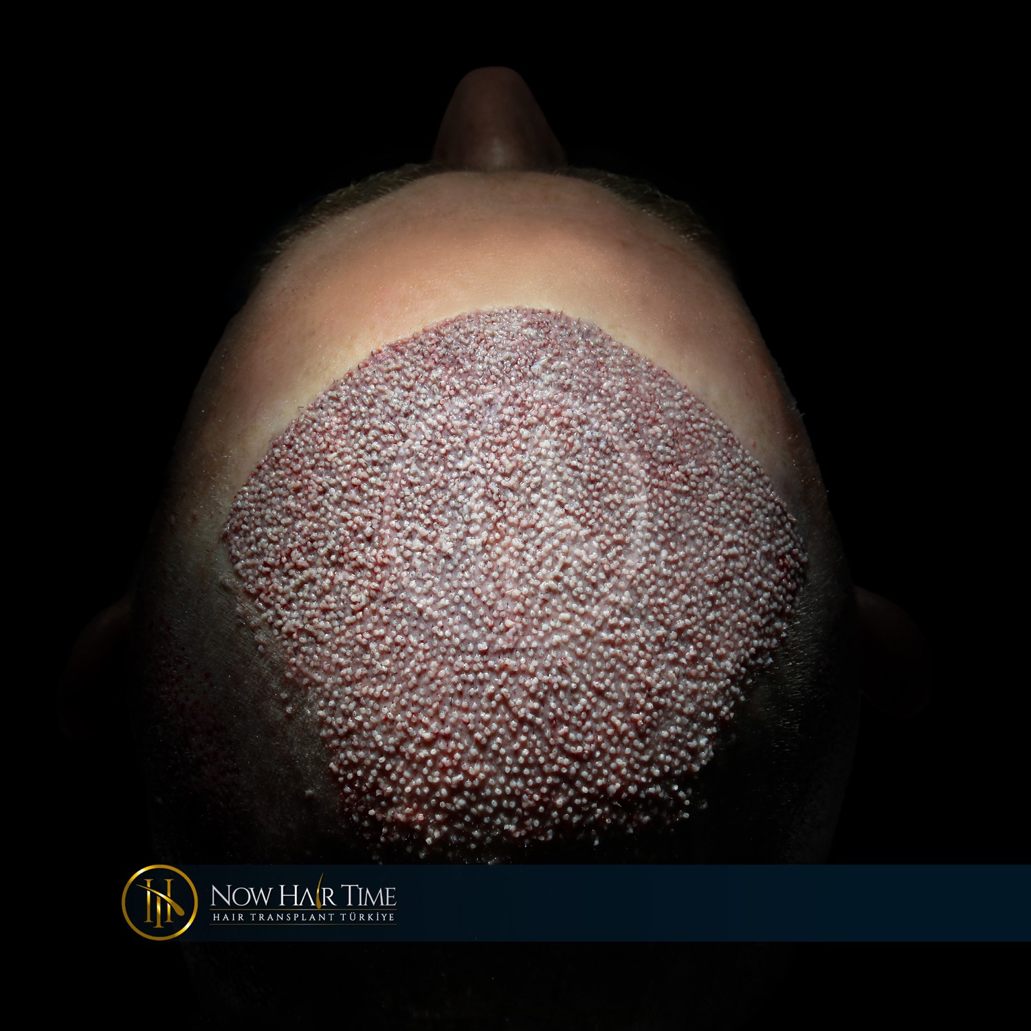 Hair Cloning & Stem Cell Hair Treatments: The Future of Hair Restoration
