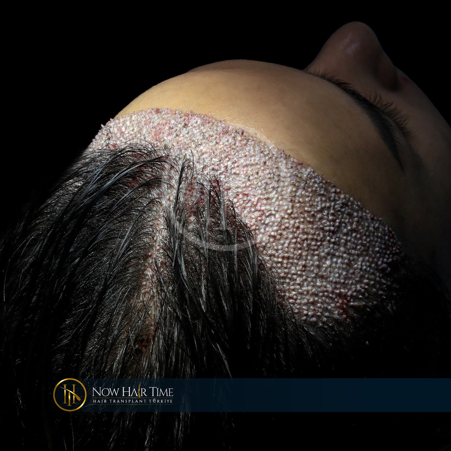 Hair transplant patient at Now Hair Time, Istanbul