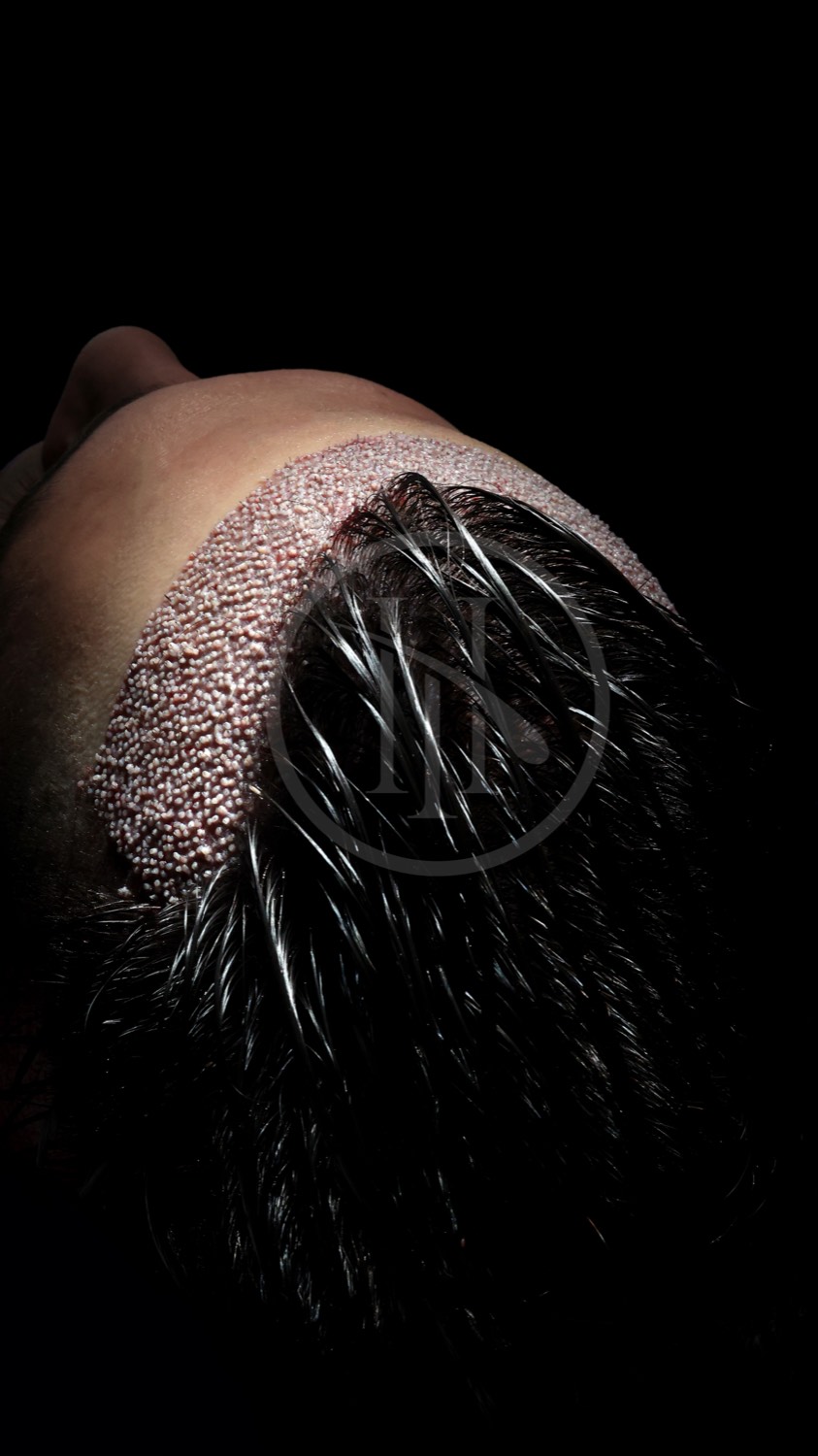 Hair transplant patient at Now Hair Time, Istanbul