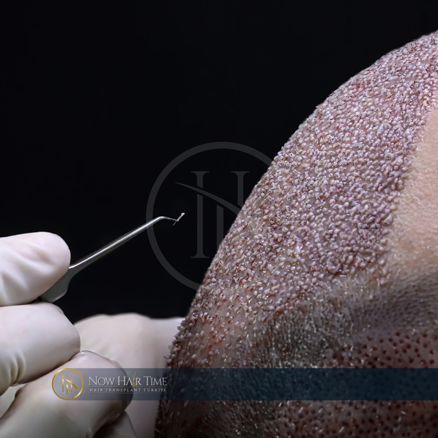 Hair transplant patient at Now Hair Time, Istanbul