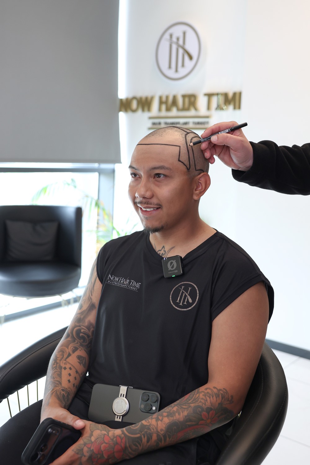 Hair transplant patient at Now Hair Time, Istanbul
