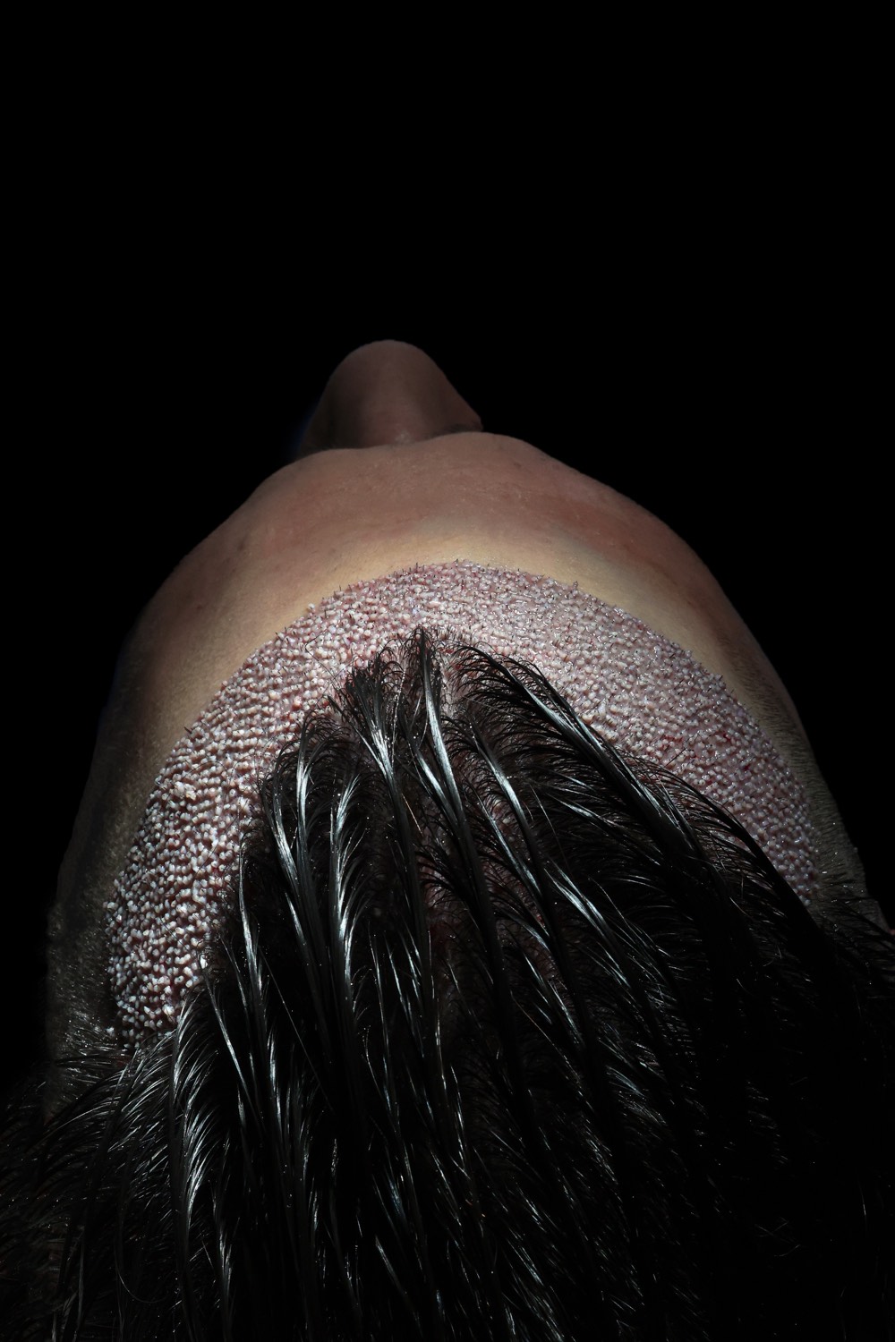 Hair transplant patient at Now Hair Time, Istanbul
