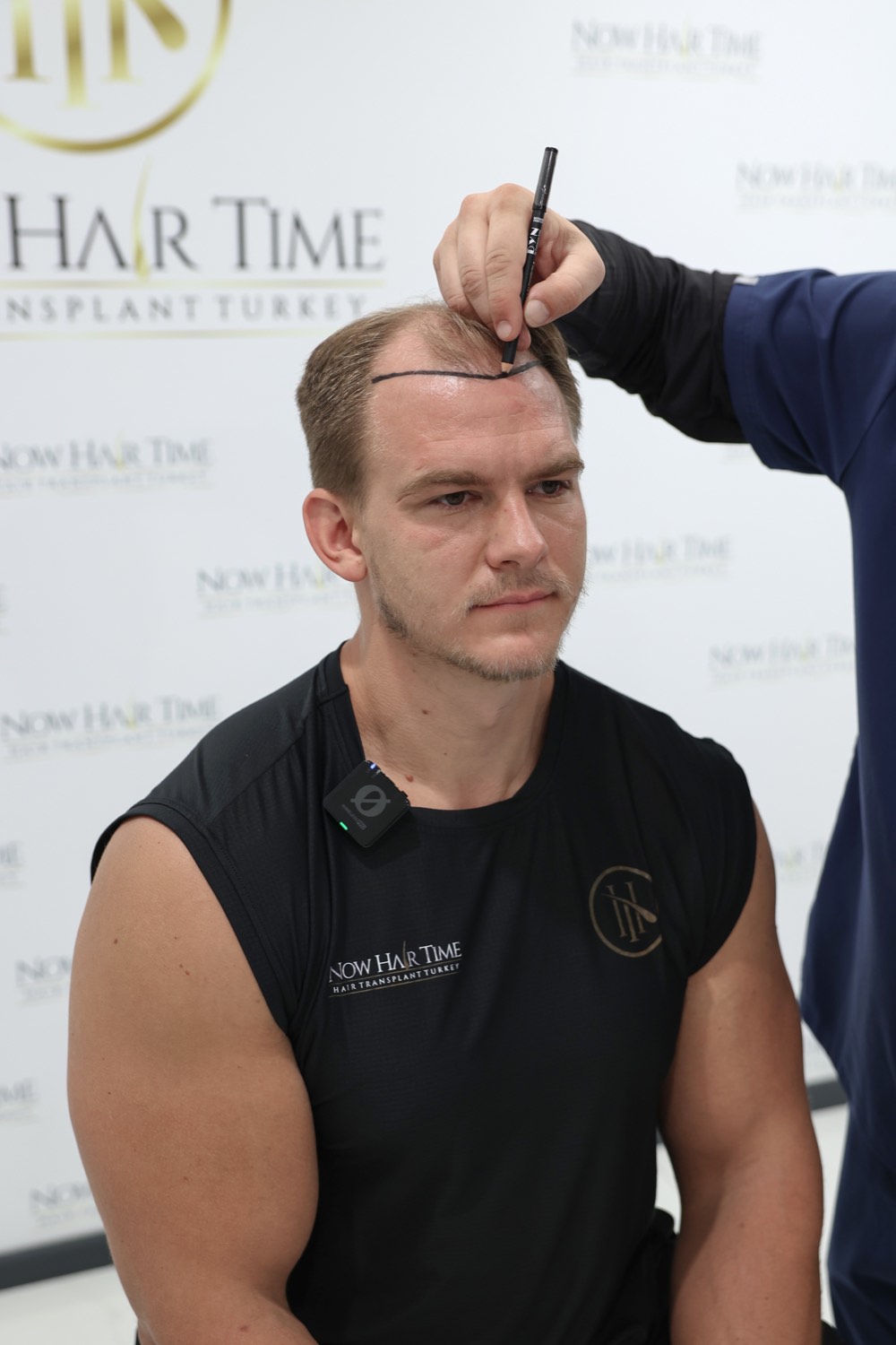 Hair transplant patient at Now Hair Time, Istanbul