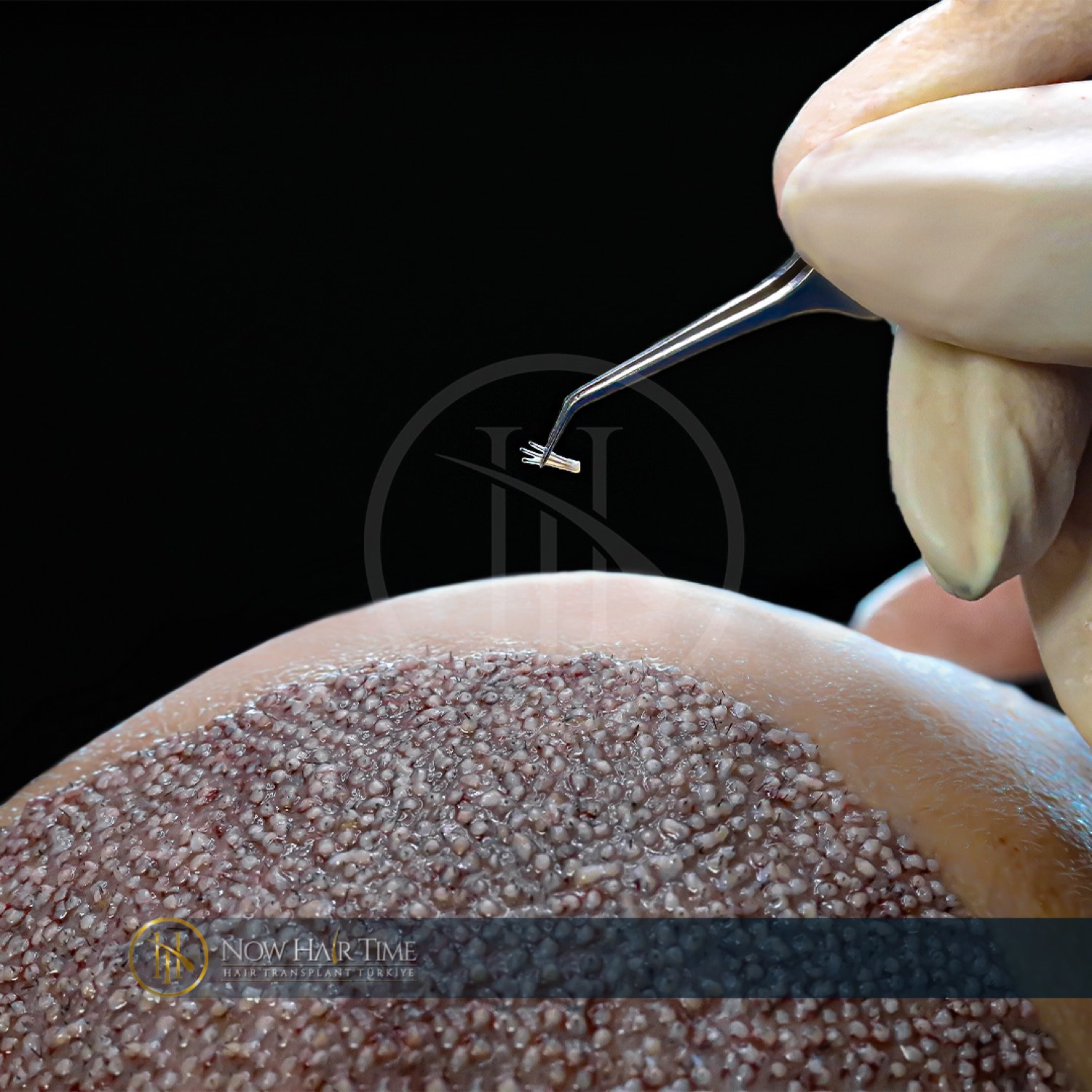 Hair transplant patient at Now Hair Time, Istanbul