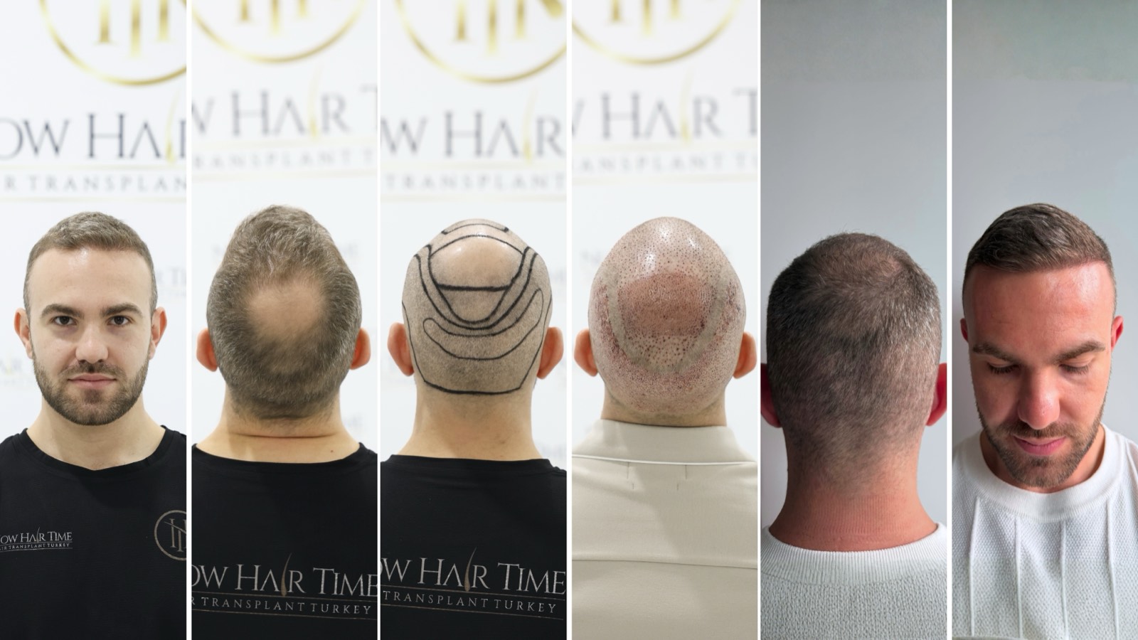 Paziente di trapianto di capelli presso Now Hair Time, Istanbul