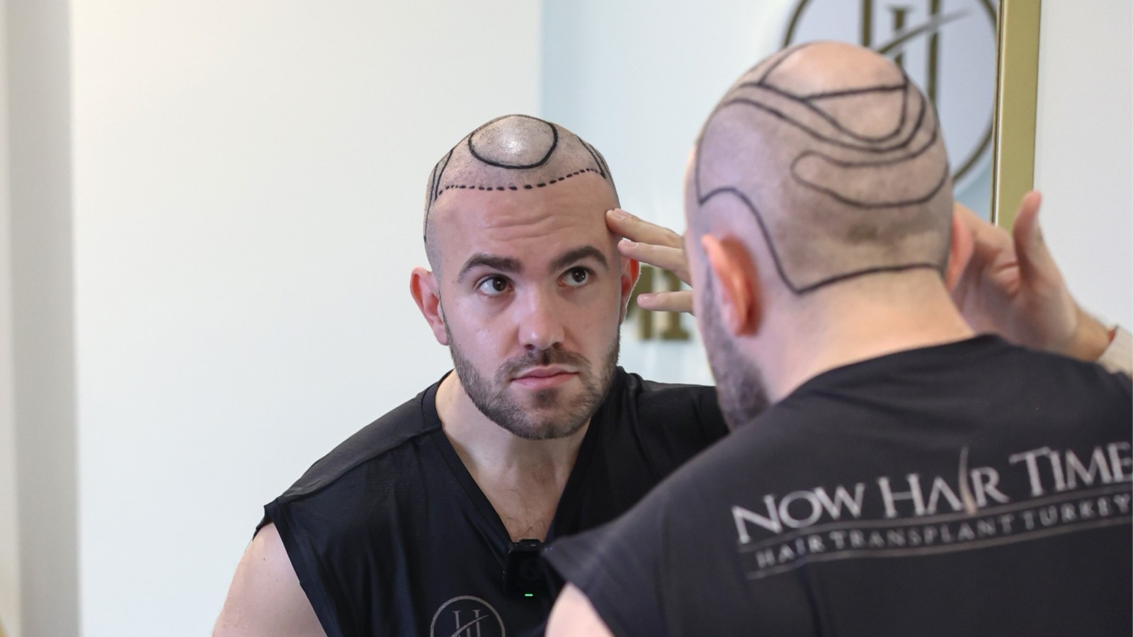 Paziente di trapianto di capelli presso Now Hair Time, Istanbul
