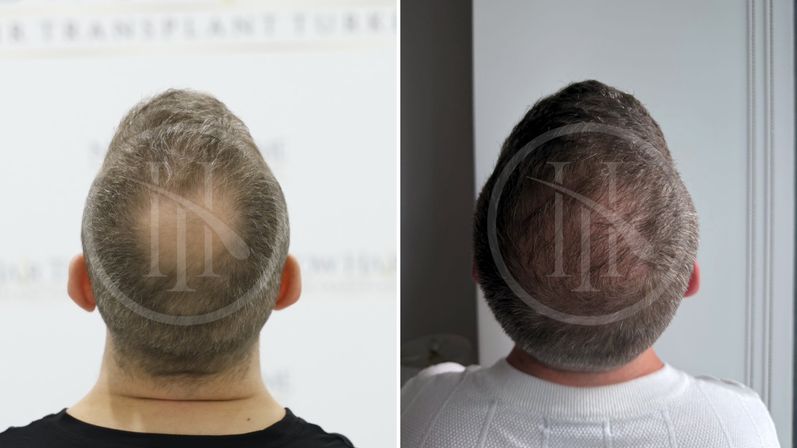 Crown (Vertex) Hair Transplant: Grafts, Swirl Pattern & What to Expect