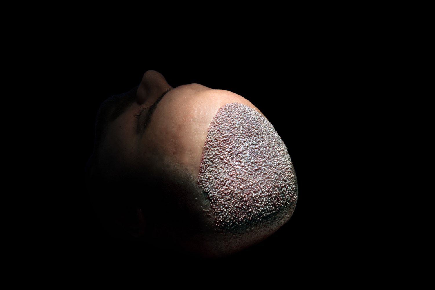 Hair transplant patient at Now Hair Time, Istanbul